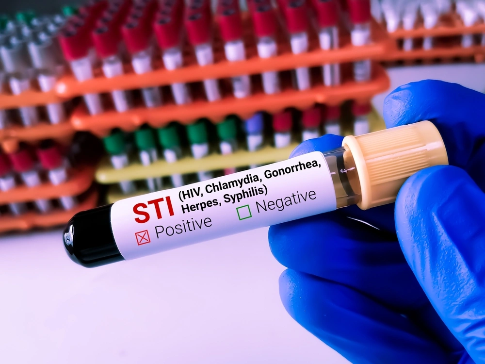 Most Common STDs in Singapore – What You Need to Know